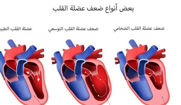 عضلة القلب الضعيفة.