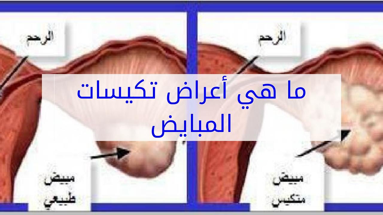 ماهي أعراض تكيسات المبايض