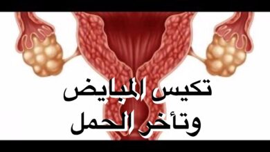 تكيس المبايض وتأخر الحمل