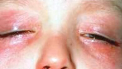 امراض تصيب العين