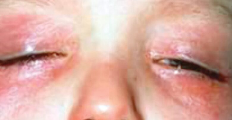 امراض تصيب العين