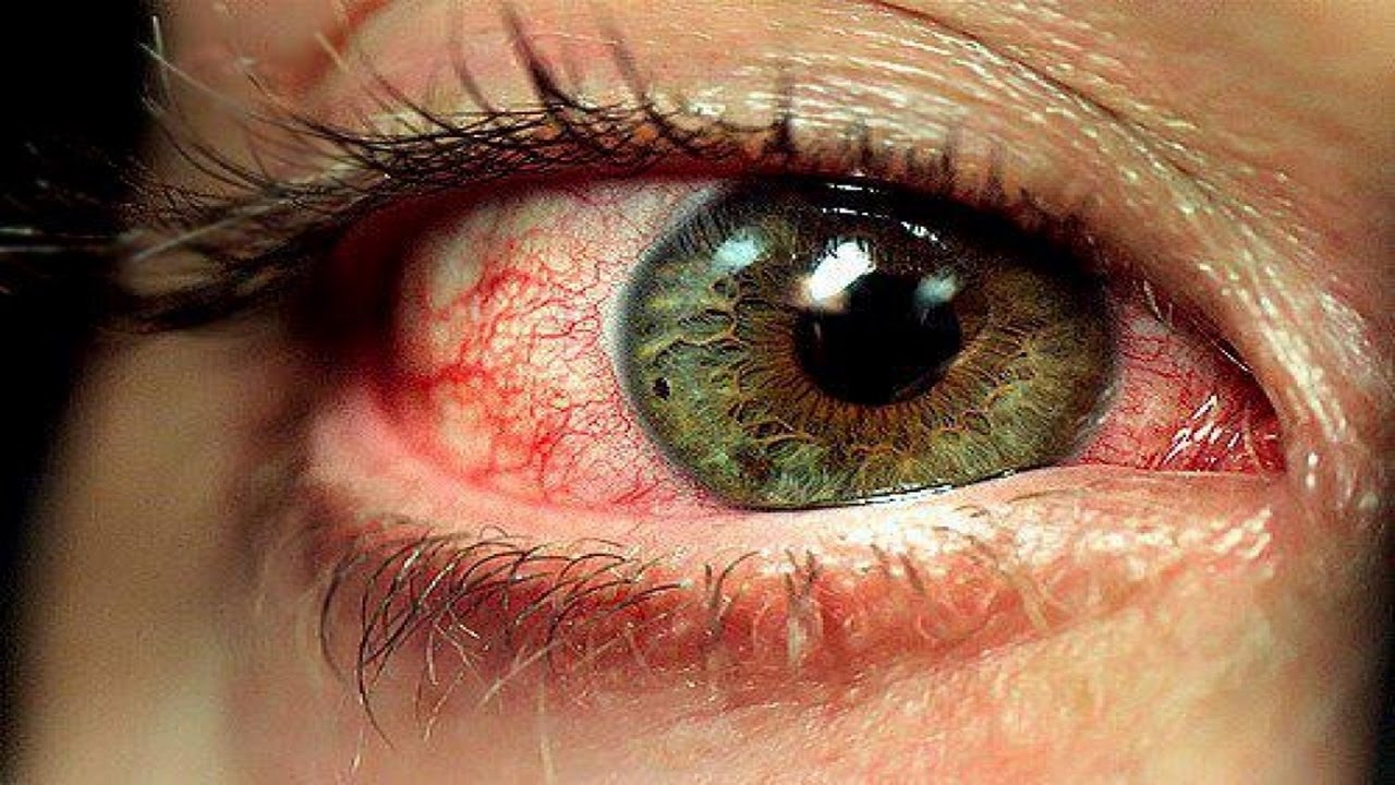 امراض العين