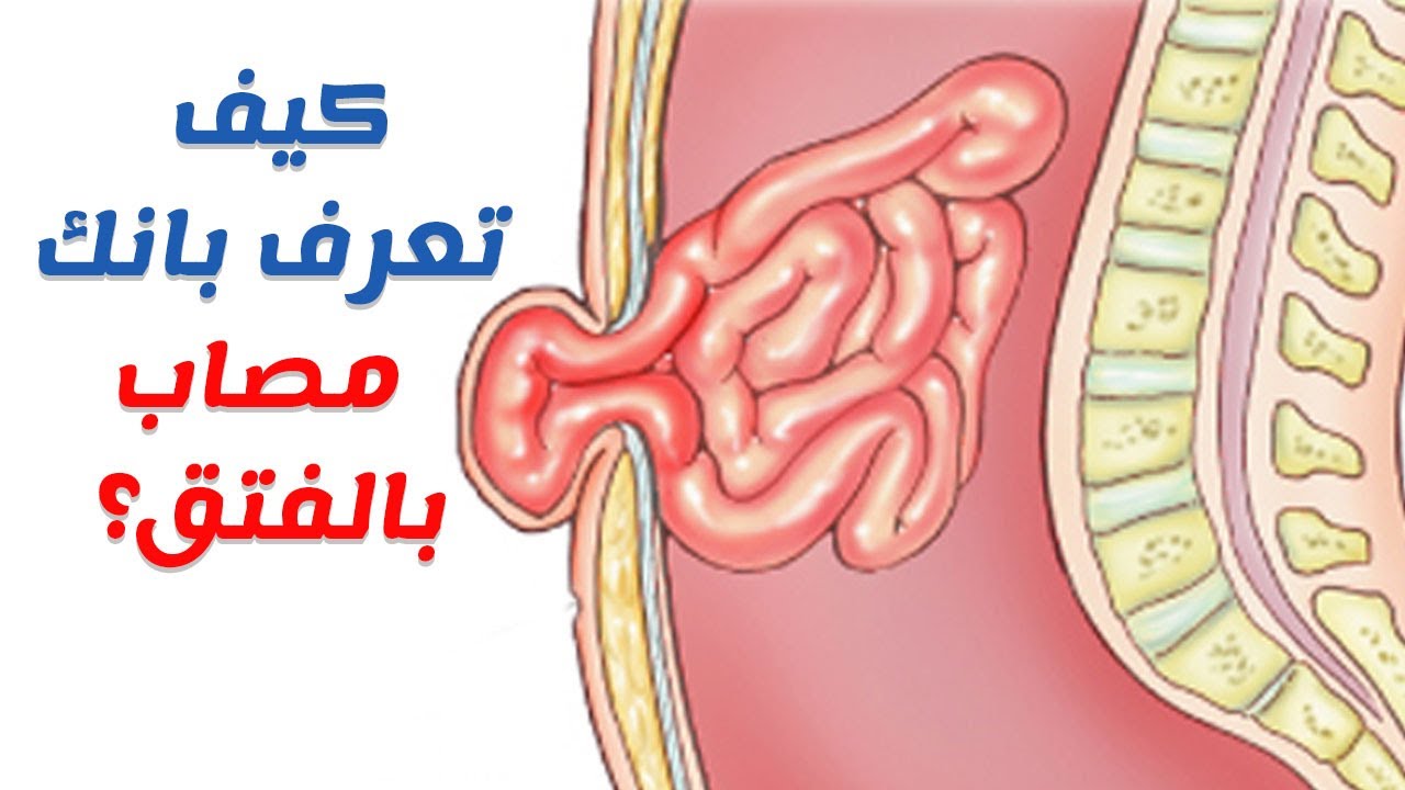 علاج الفتاق