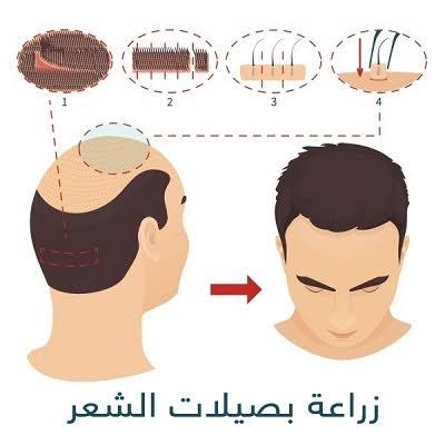 زراعة الشعر