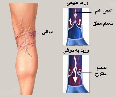 أعراض دوالى الساقين