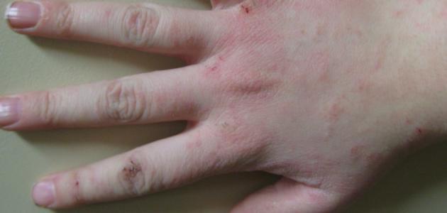 سرطان الجلد في اليد