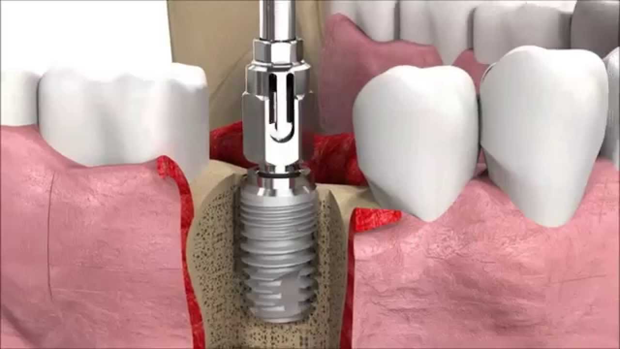 كيفية زراعة الاسنان ومراحل عملية الغرس كاملة