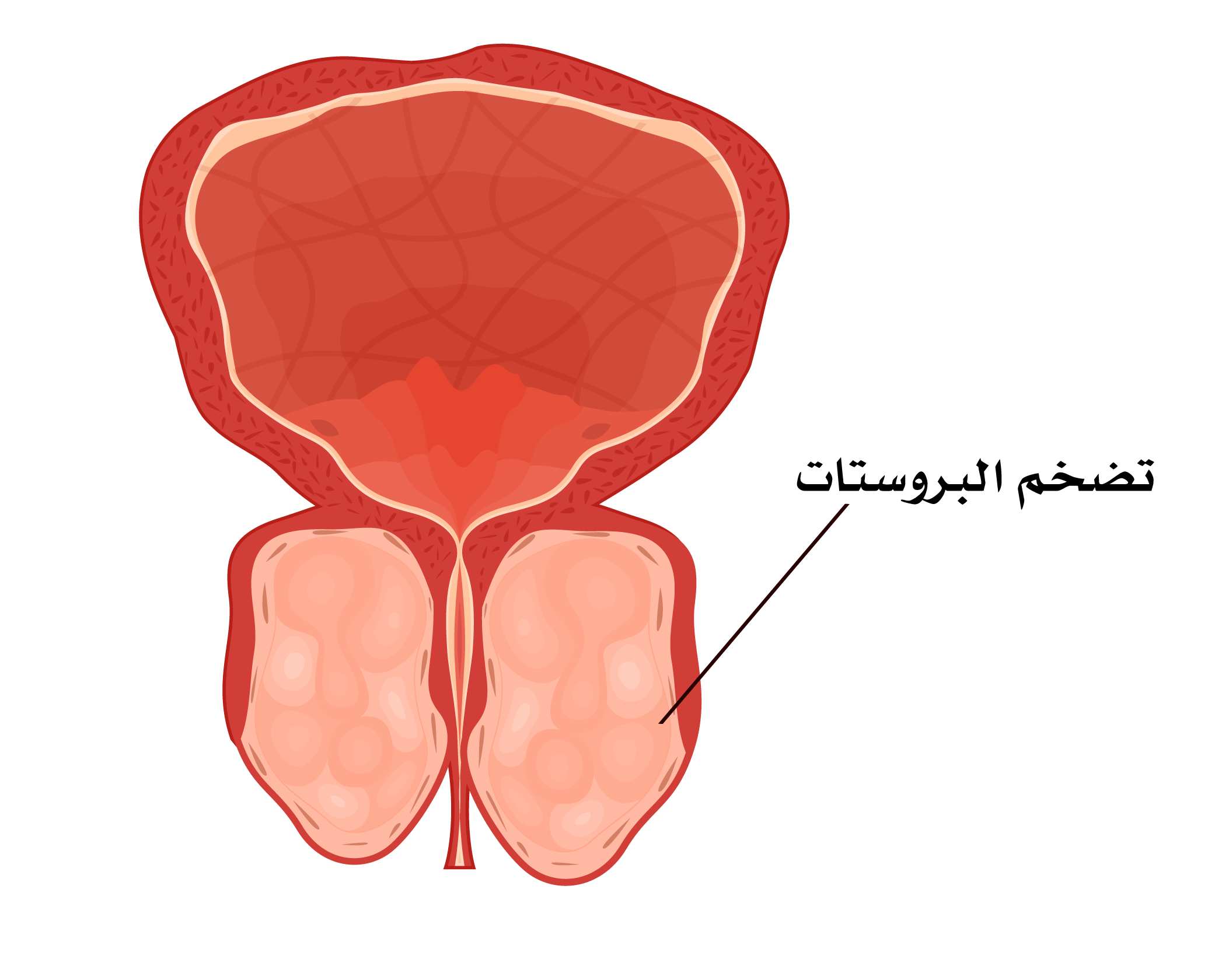 تضخم البروستاتا