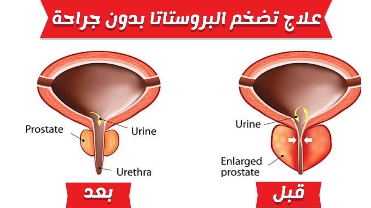 علاج تضخم البروستاتا