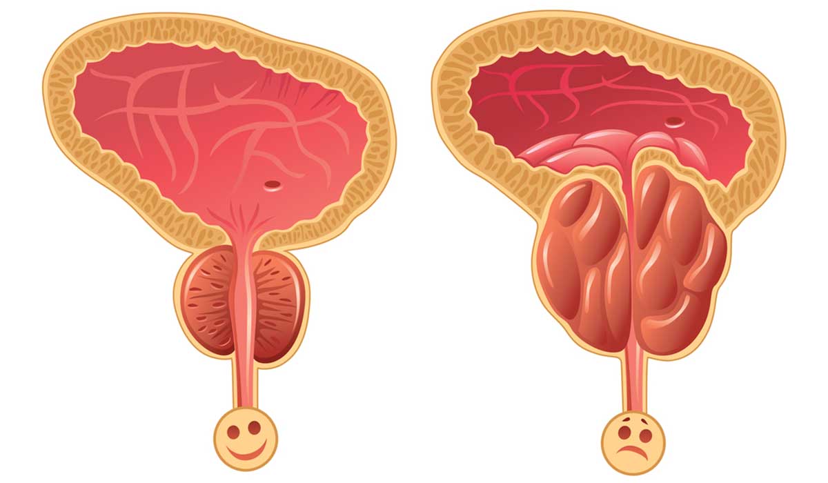 الفرق بين البروستاتا السليمة والمتضخمة
