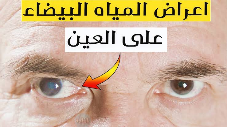 أعراض المياه البيضاء