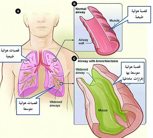 ضيق الشعب الهوائية