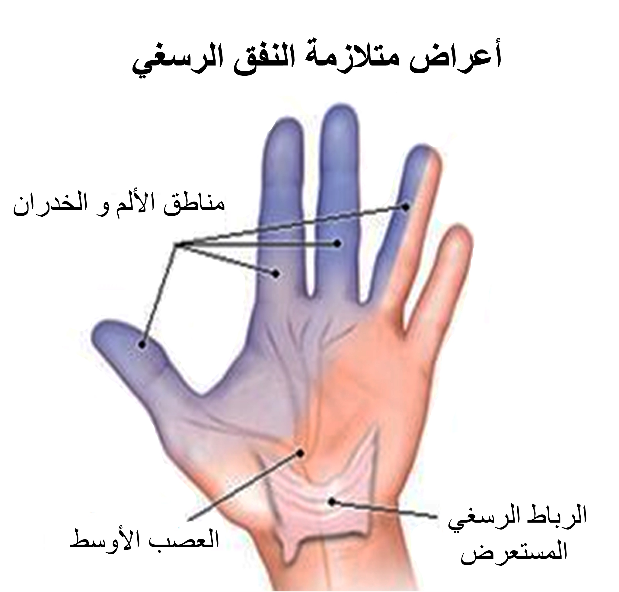 أعراض متلازمة النفق