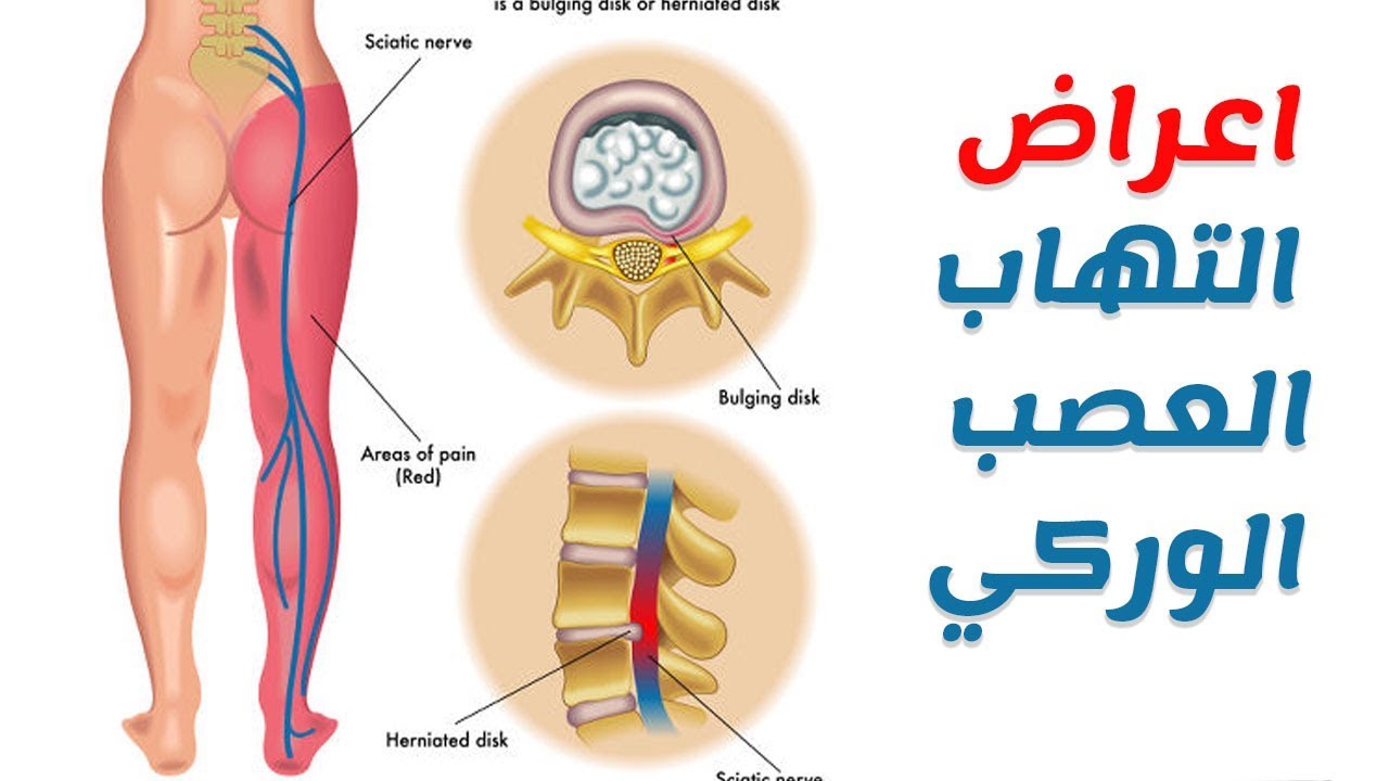 أعراض التهاب العصب الوركي