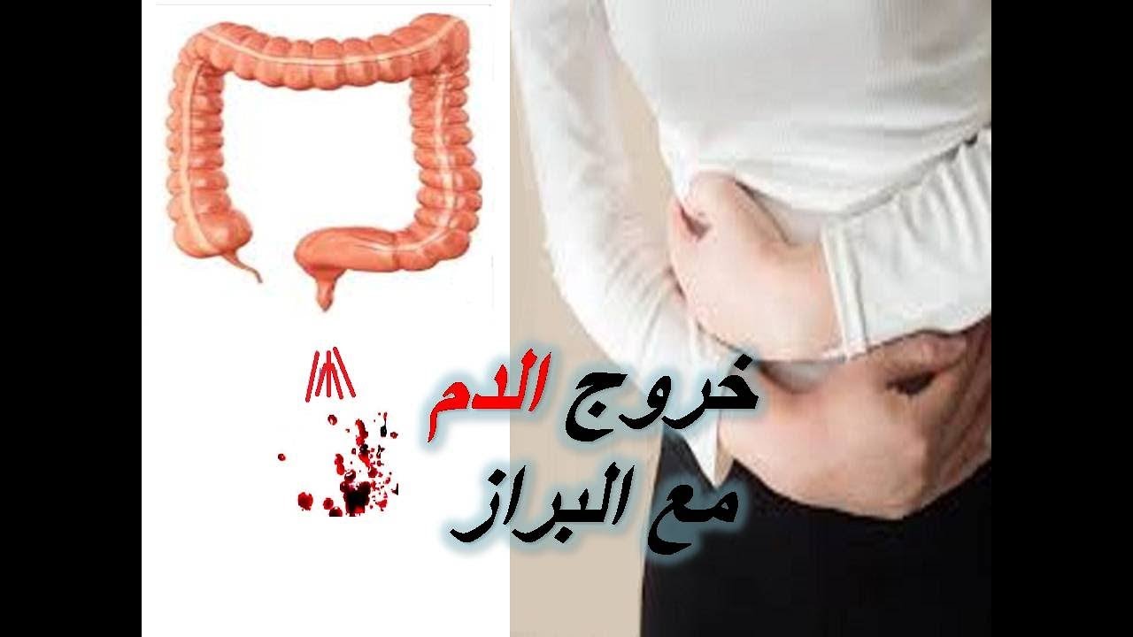 خروج الدم مع البراز