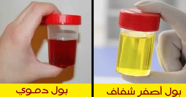 الفرق بين البول العادي و البول الدموي.