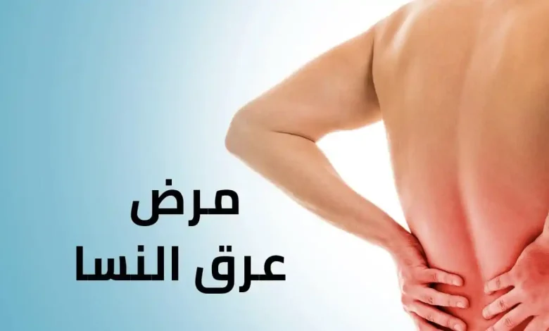 مرض عرق النسا وعلاجه