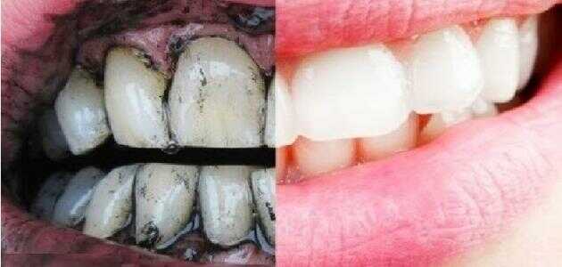 طريقة الفحم لتبيض الأسنان