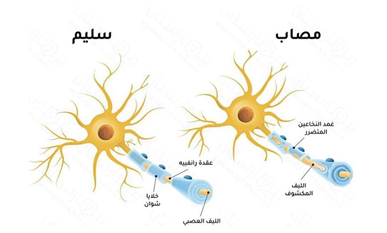 ما هو مرض التصلب اللويحي؟ هل هناك حالات شفيت من المرض؟